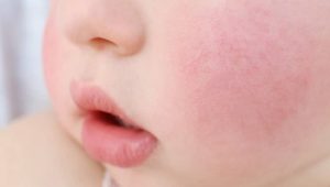 علائم حساسیت به برنج در نوزادان